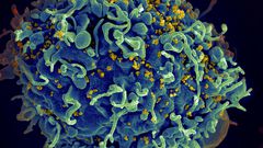 As word of a second HIV cure spreads, patients wonder: What now?