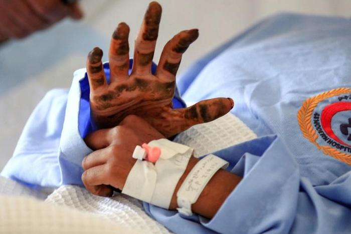 A Yemeni girl receives treatment at a hospital in the capital Sanaa for wounds sustained during an air strike in northern Hajjah province