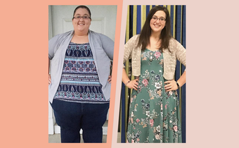 'I Lost 336 Pounds And Had Loose Skin Removed'