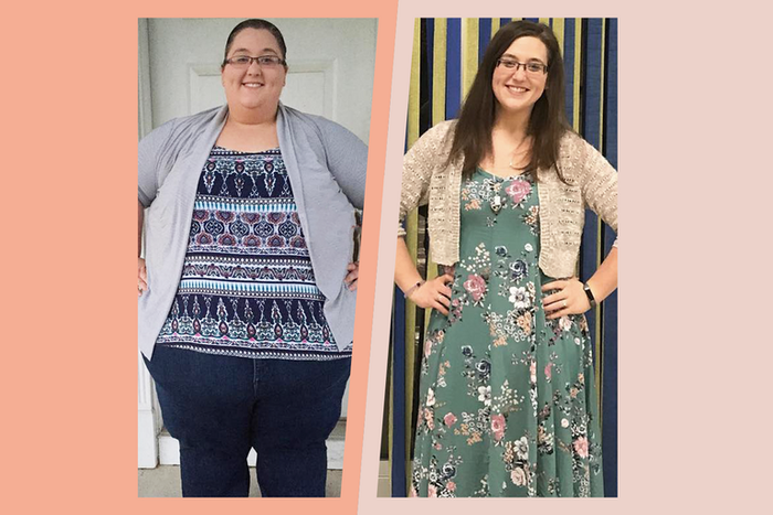 'I Lost 336 Pounds And Had Loose Skin Removed'