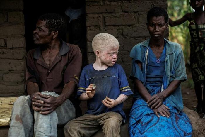 Scores of people with albinism have been attacked or kidnapped in Malawi, say campaigners. Many are believed to have been targeted for body parts, to be used in witchcraft