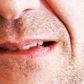 How To Get Rid of a Pimple On Your Lip