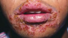 gonorrhea