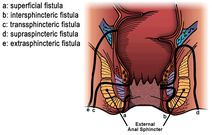 Obstetrics fistula and its alarming devastation of Ghanaian women