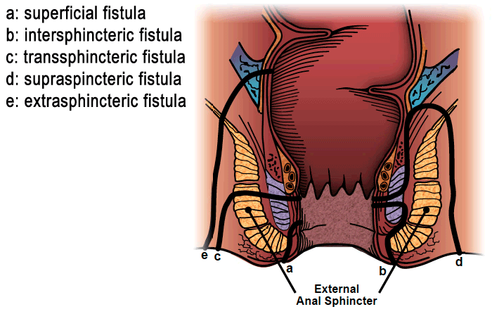 Obstetrics fistula and its alarming devastation of Ghanaian women