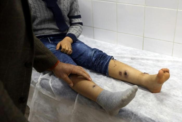 A boy receives treatment for leishmaniasis at the Bir Al-Ostah Milad Hospital for Dermatology in the Libyan capital, Tripoli on February 11, 2019