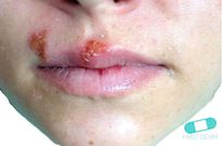 Oral herpes