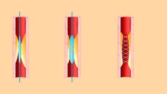 When to Say No to a Heart Stent