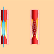 When to Say No to a Heart Stent