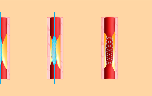 When to Say No to a Heart Stent