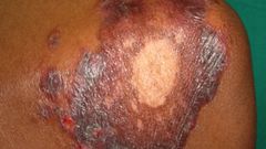 Syphilis
