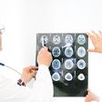 Closing In on Alzheimer's Disease
