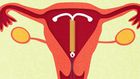 8 Facts About Sex When You Have An IUD