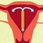 8 Facts About Sex When You Have An IUD