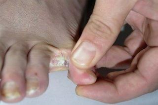 Athlete's foot