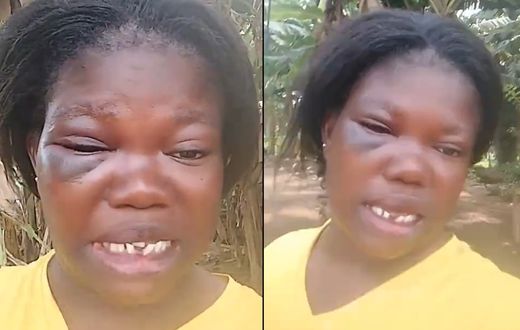 Woman with black eye after brutal beating by lover