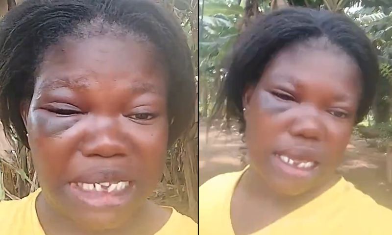 Woman with black eye after brutal beating by lover