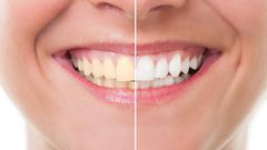 Teeth whitening (credit - Amazon.com)