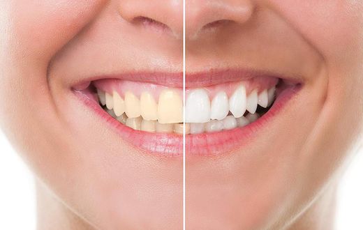Teeth whitening (credit - Amazon.com)