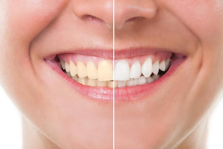Teeth whitening (credit - Amazon.com)