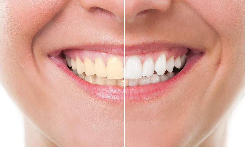 Teeth whitening (credit - Amazon.com)