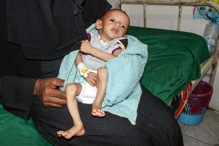 A malnourished child receiving treatment at a hospital in Yemen: a UN report said more than 821 million people worldwide suffered from hunger in 2018