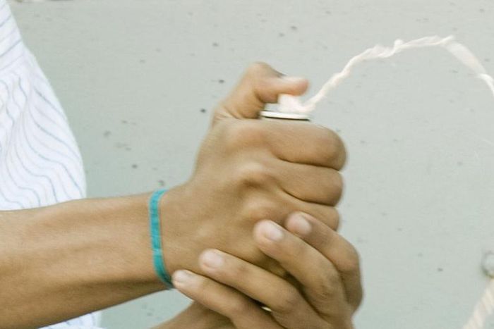 This Steatocystoma Pop Looks Like Silly String