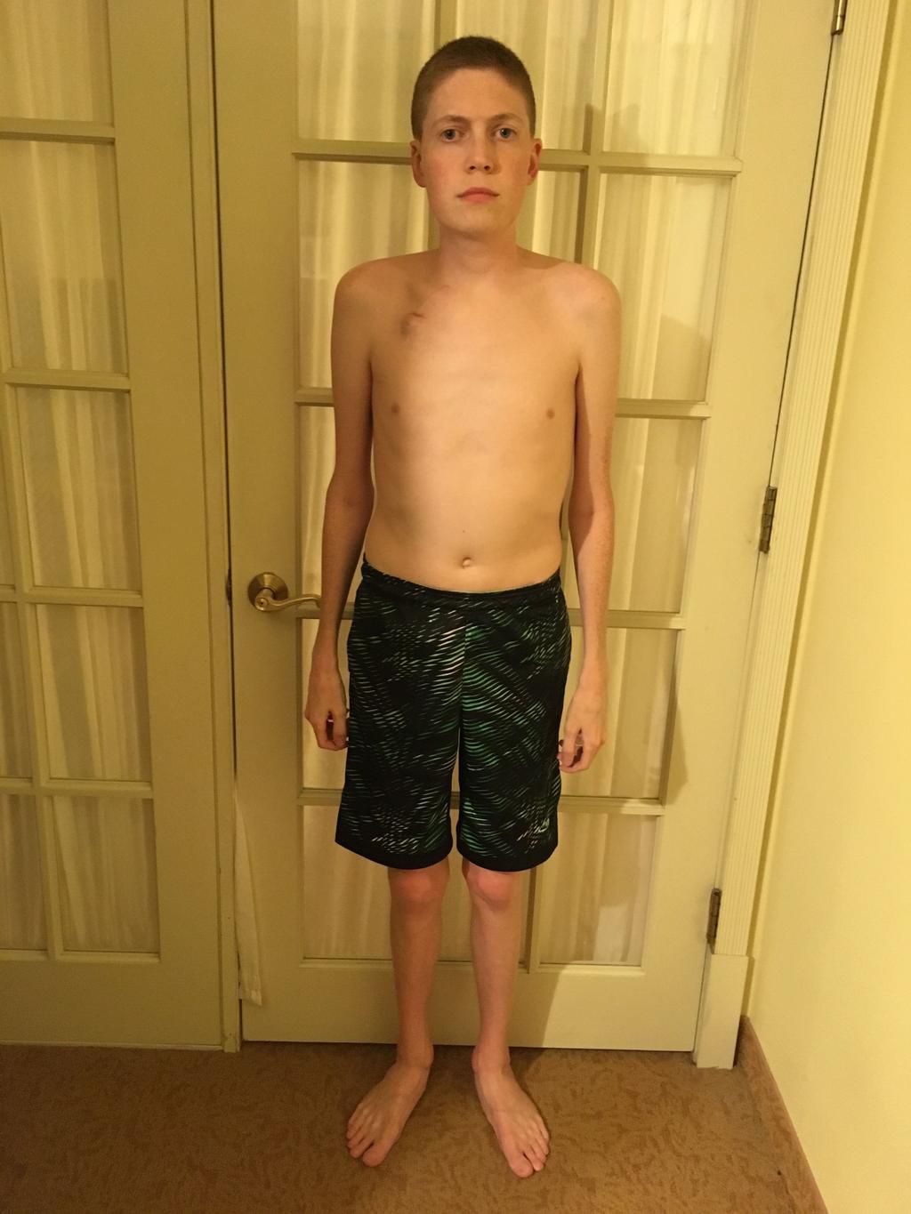 Gates, before the gastrojejunostomy procedure.