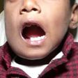 Doctors remove 526 teeth from a 7-year old boy's mouth