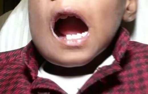 Doctors remove 526 teeth from a 7-year old boy's mouth