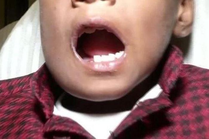 Doctors remove 526 teeth from a 7-year old boy's mouth