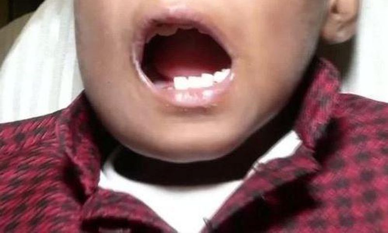 Doctors remove 526 teeth from a 7-year old boy's mouth