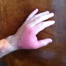 Do You Have A Spider Bite? These 7 Photos Can Help You Tell