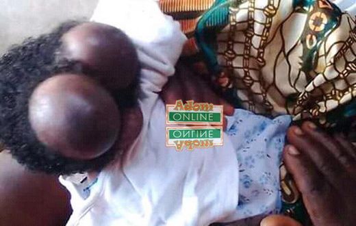 20-year-old woman gives birth to baby with two heads at Swedru
