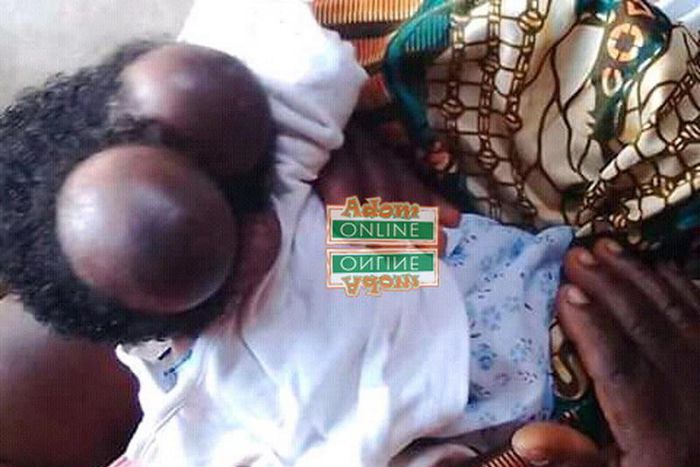 20-year-old woman gives birth to baby with two heads at Swedru