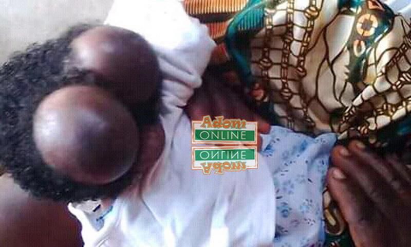 20-year-old woman gives birth to baby with two heads at Swedru