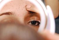 Acne-causing foods (photocredit: WebMD)