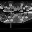 Doctors discover 526 extra teeth in 7-year-old boy’s mouth (photos)