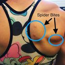 Do You Have A Spider Bite? These 7 Photos Can Help You Tell