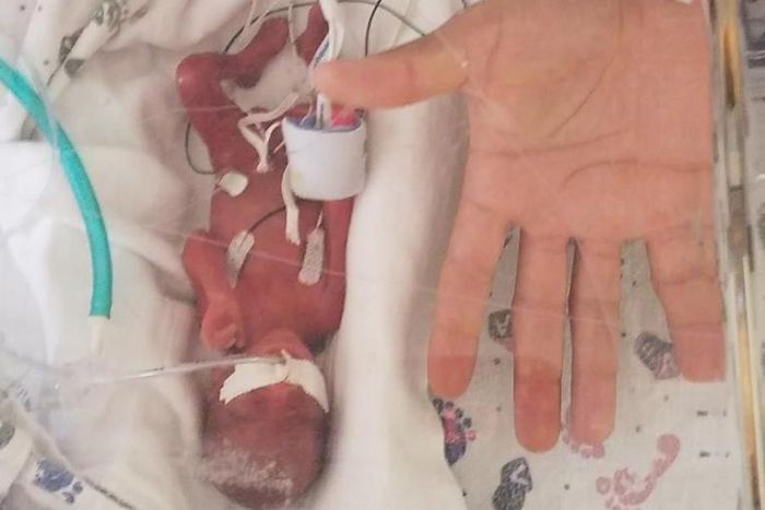 Iowa Mom Gives Birth 4 Months Early