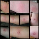 Do You Have A Spider Bite? These 7 Photos Can Help You Tell
