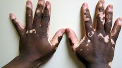 Vitiligo