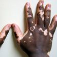 Vitiligo