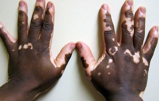 Vitiligo