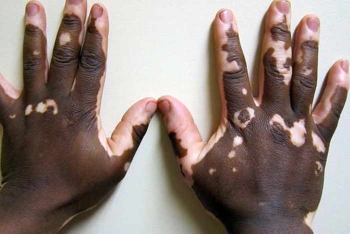 Vitiligo