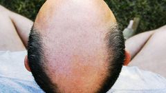 7 Ways to Slow Down Hair Loss
