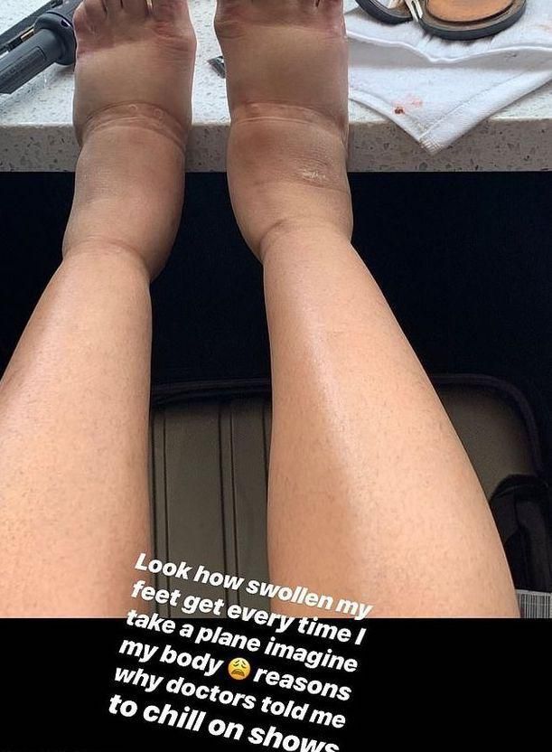 Cardi B Shares Photo Of Extremely Swollen Feet