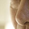 Dr. Pimple Popper Reshaped a Man's Nose