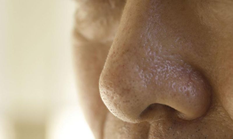 Dr. Pimple Popper Reshaped a Man's Nose