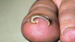 Ingrown toenail (Credit - MedicineNet)